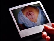 Flukeman wound in photograph