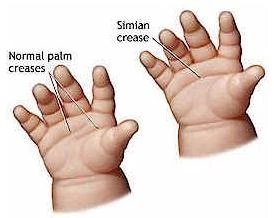 cri du chat syndrome karyotype images