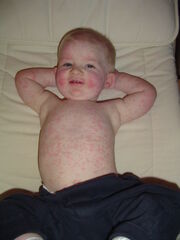 Fifth disease