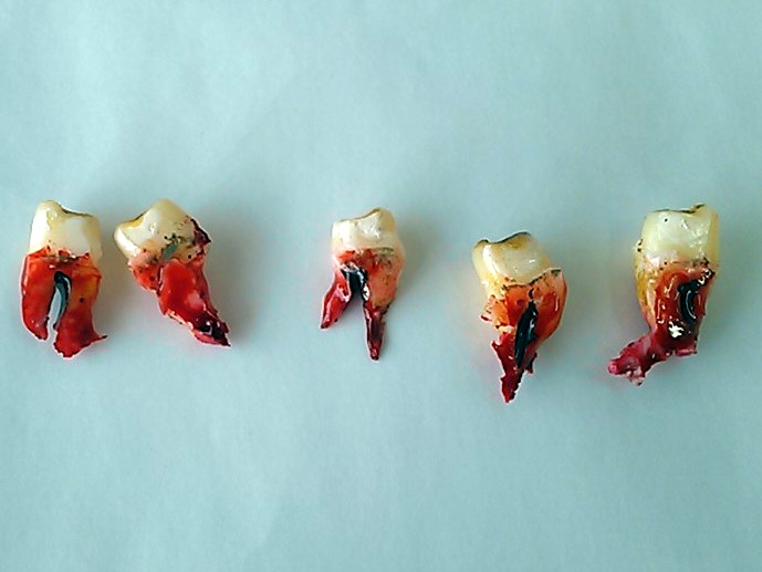 Image - Cropped-bloody-teeth.jpg - Spinpasta Wiki